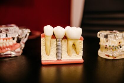 dental implants in Kent