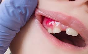 How Long Until a Tooth Infection Kills You